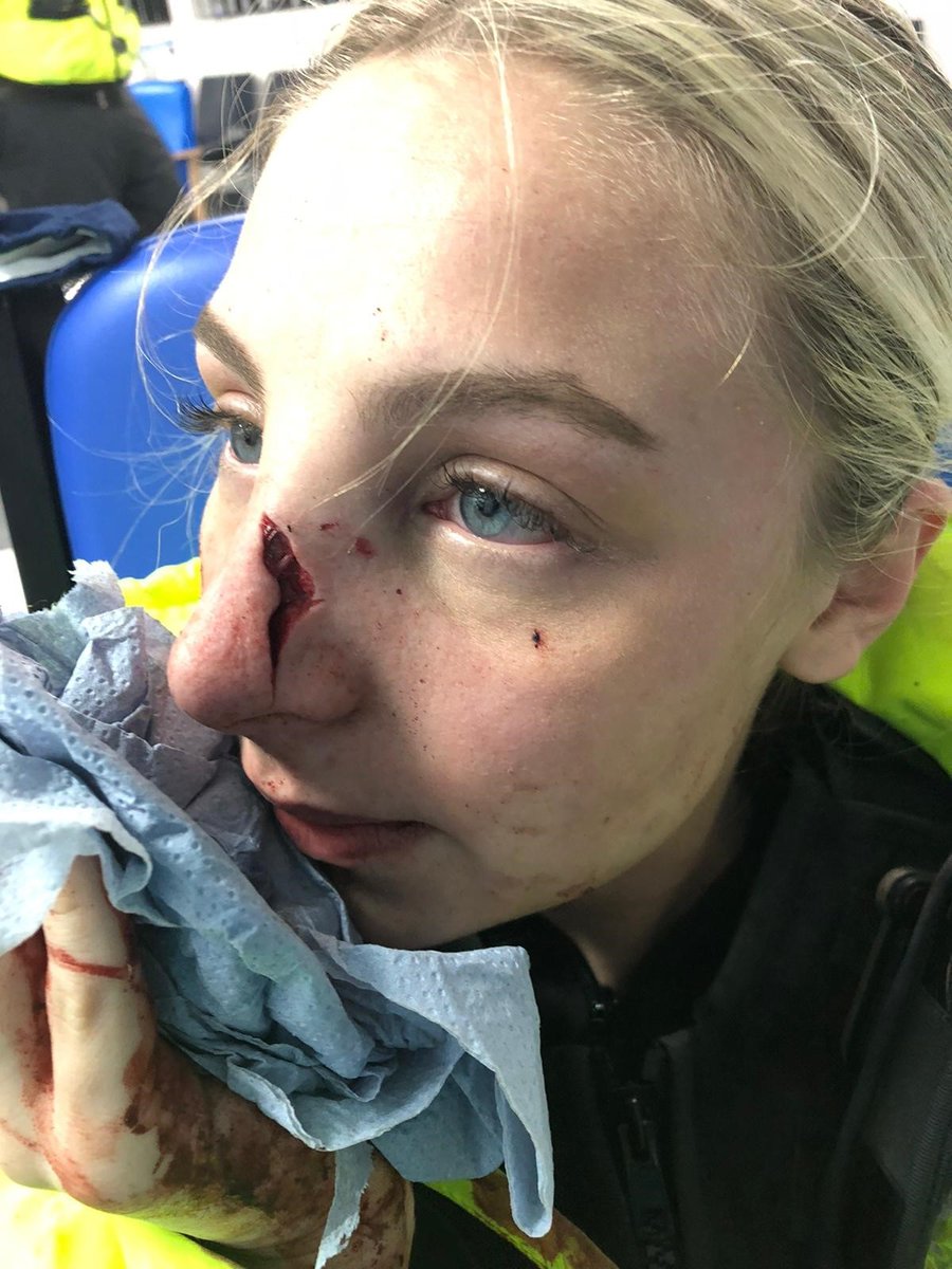 leicspolice's tweet image. These are the horrific injuries an officer suffered when assaulted

The injuries left a police officer needing facial surgery after she was assaulted when trying to detain a 16-year-old youth.

Read the full story here ➡️ leics.police.uk/news/leicester…