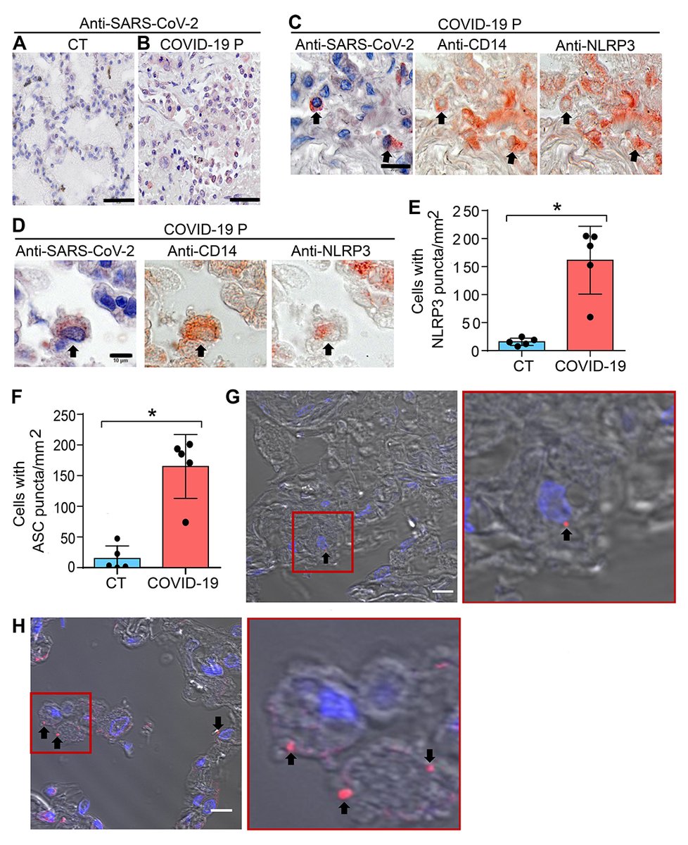 Journal of Experimental Medicine (@jexpmed) on Twitter photo Lung histopathological analysis and NLRP3 activation in fatal cases of COVID-19. From <a href="/tamrodrigues1/">Tamara Rodrigues</a>, <a href="/ZamboniLab/">Dario S. Zamboni</a> et al. who report that #Inflammasomes are activated in response to #SARSCoV2 infection and are associated with #COVID19 severity in patients: bit.ly/2UZ4hXj Lung histopathological analysis and NLRP3 activation in fatal cases of COVID-19. From <a href="/tamrodrigues1/">Tamara Rodrigues</a>, <a href="/ZamboniLab/">Dario S. Zamboni</a> et al. who report that #Inflammasomes are activated in response to #SARSCoV2 infection and are associated with #COVID19 severity in patients: bit.ly/2UZ4hXj