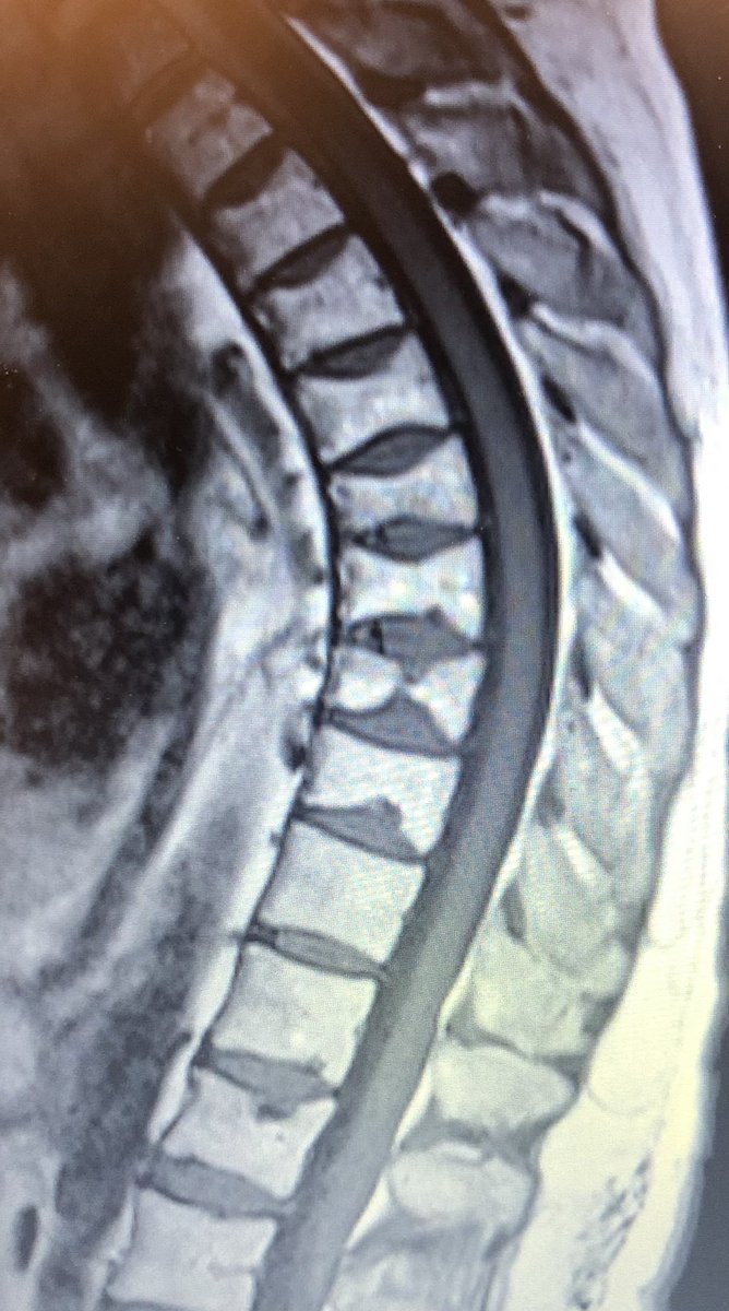 dougbeall's tweet photo. 8 spine fractures #VCFs and 5 yrs of pain. No referral for #vertebralaugmentation No anabolic bone agents. This demonstrates a huge need for eduction in treating and managing osteoporotic fractures. @ASBMR @NottsOsteoporo1 @OsteoporosisNOF @RoyalOsteoSoc @iofbonehealth @ASIPP https://t.co/XzFmsUpwkz