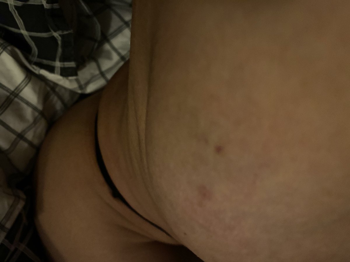 miss_Grey_76's tweet photo. Lite om och blå men det blir bra snart! #biopsi #mammografi #blåmärke https://t.co/YaDKYdmUDB
