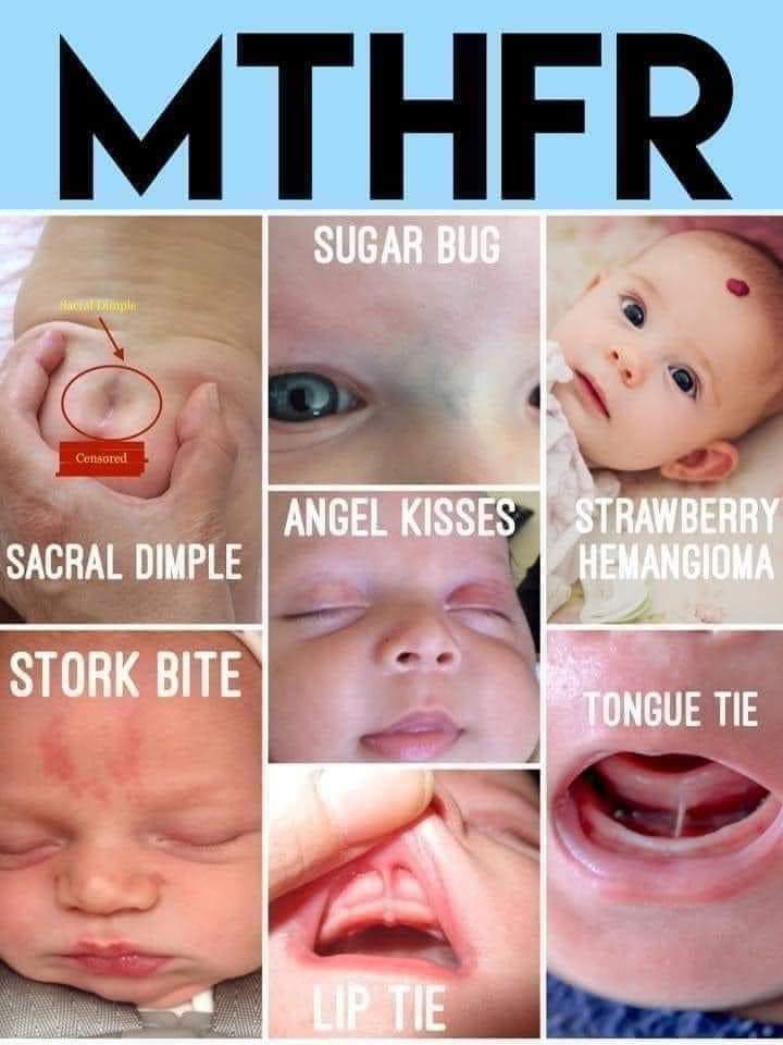  MTHFR Have you or your child ever had any of these marks? These marks are indicators of a mutation to the MTHFR gene. Many of you may have heard of MTHFR by now,no that’s not an abbreviation for the curse word 