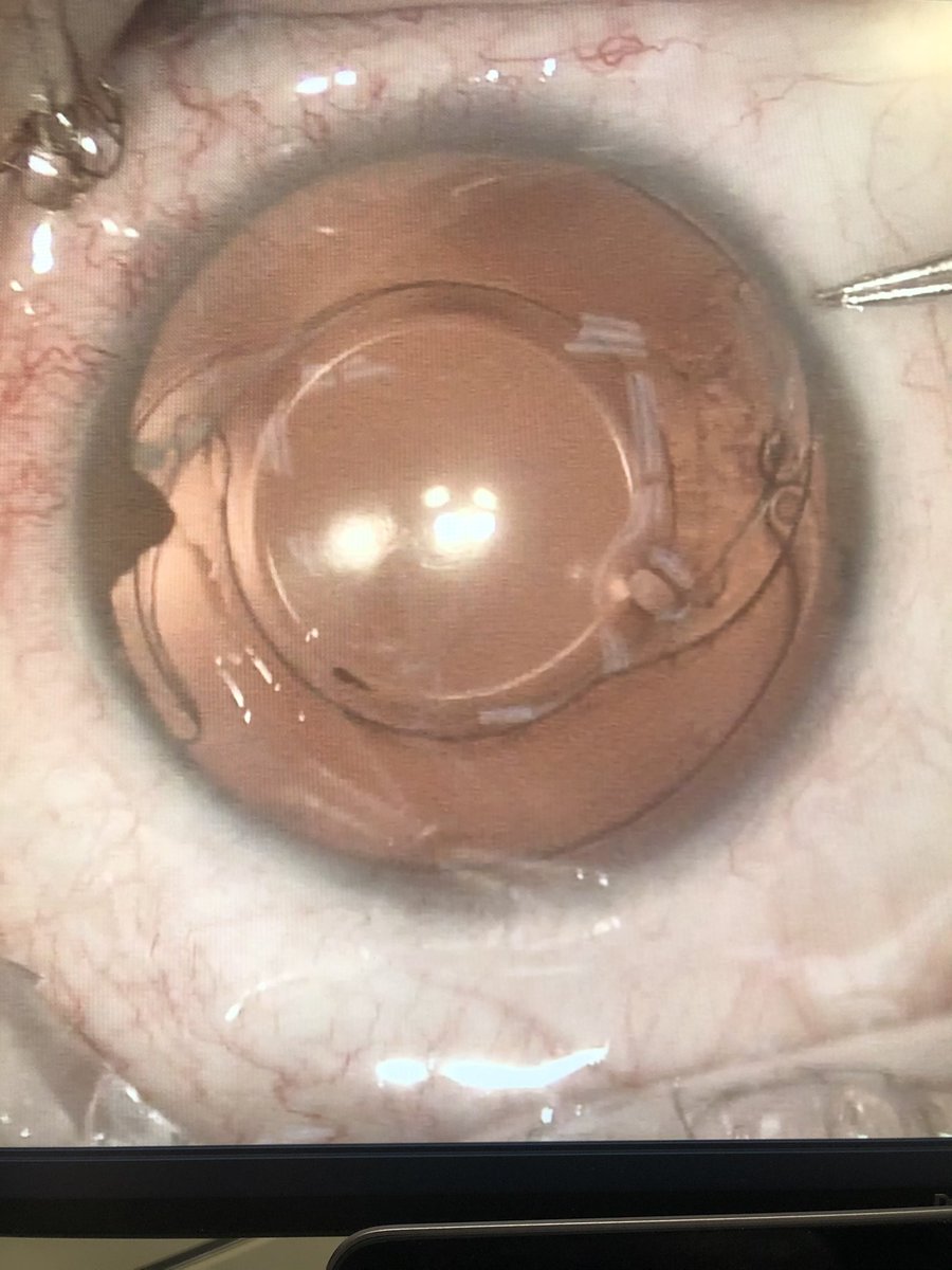 migreenw's tweet image. How it started vs how it’s going 

Special thanks to Brandon Ayres for some tips

@humanoptics artificial iris #customflex