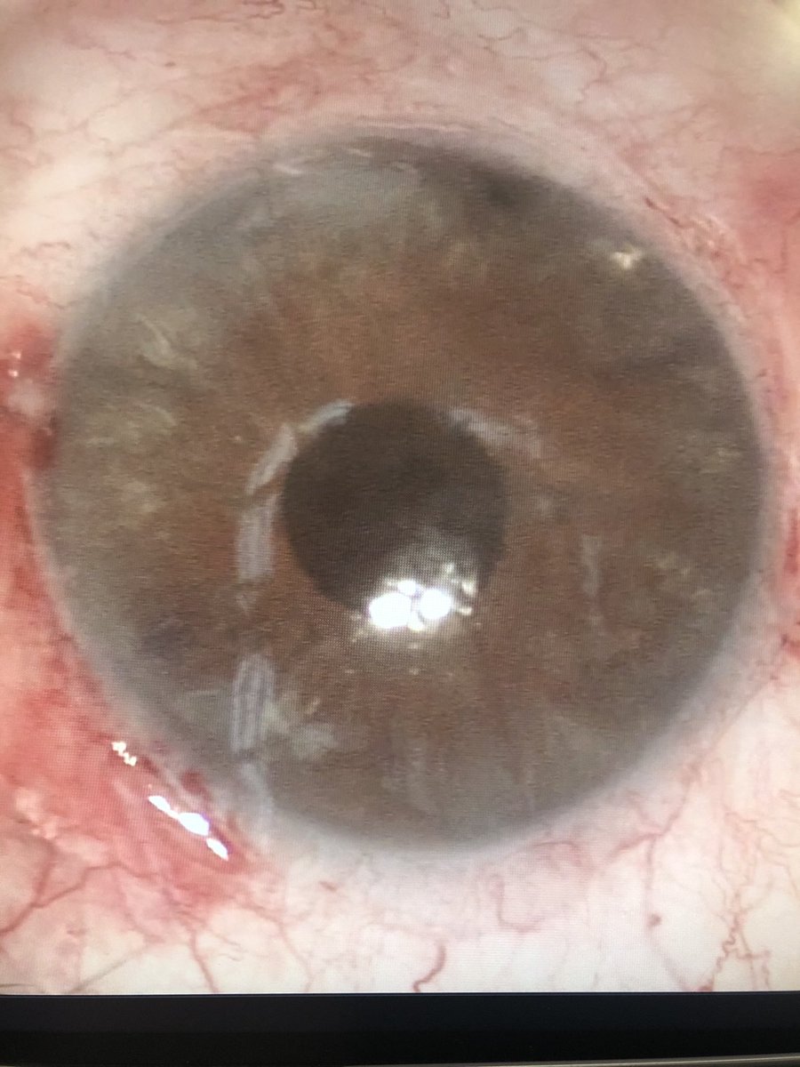migreenw's tweet image. How it started vs how it’s going 

Special thanks to Brandon Ayres for some tips

@humanoptics artificial iris #customflex