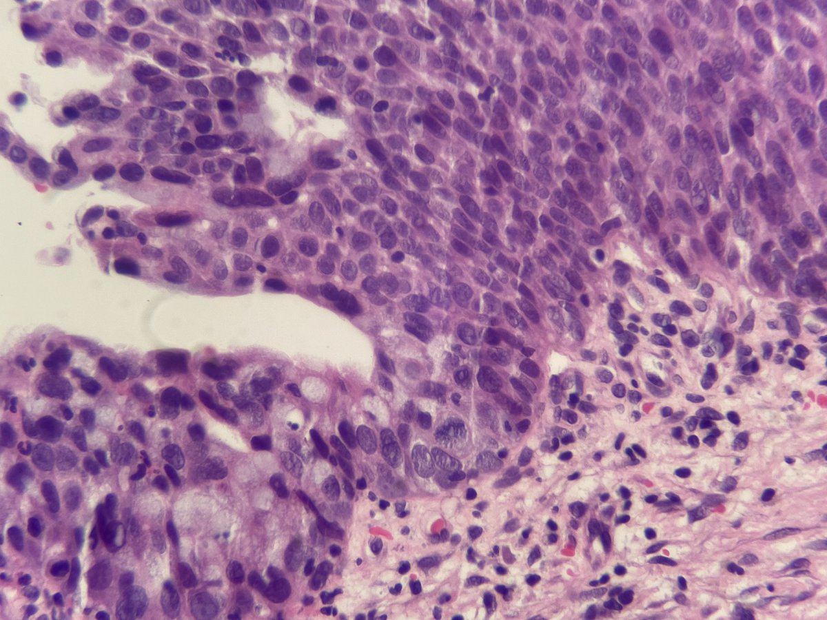 CNGMD1's tweet photo. Example of SMILE lesion of the cervix.  Stratified Mucin-producing intra epithelial lesion.  Thought to be a variant of AIS that occurs along with HGSIL.  HPV-driven.  p16 block positive and Ki-67 increased to top layers.  PMID: 26523540. https://t.co/4rdPdgXjlm
