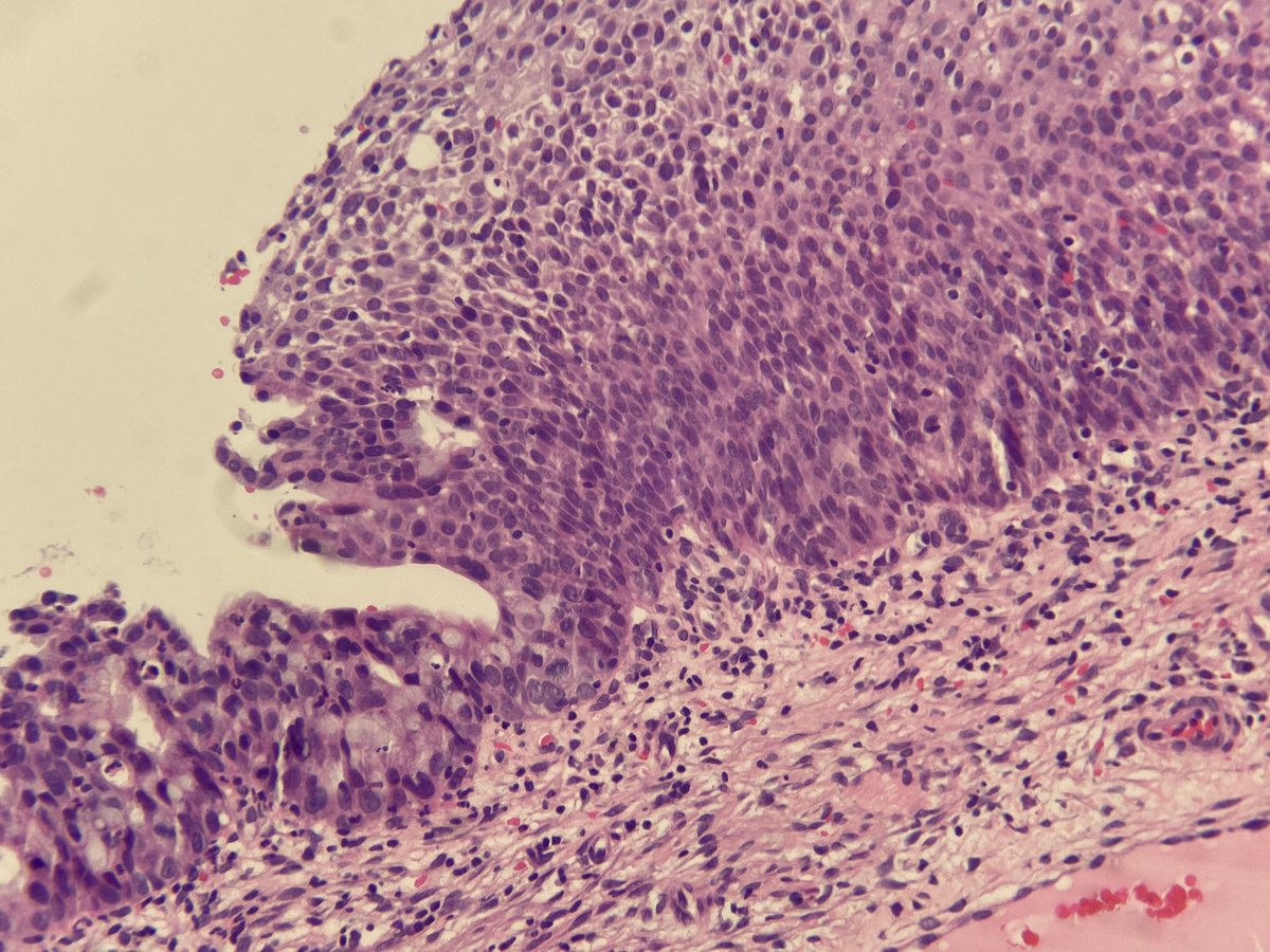 CNGMD1's tweet photo. Example of SMILE lesion of the cervix.  Stratified Mucin-producing intra epithelial lesion.  Thought to be a variant of AIS that occurs along with HGSIL.  HPV-driven.  p16 block positive and Ki-67 increased to top layers.  PMID: 26523540. https://t.co/4rdPdgXjlm