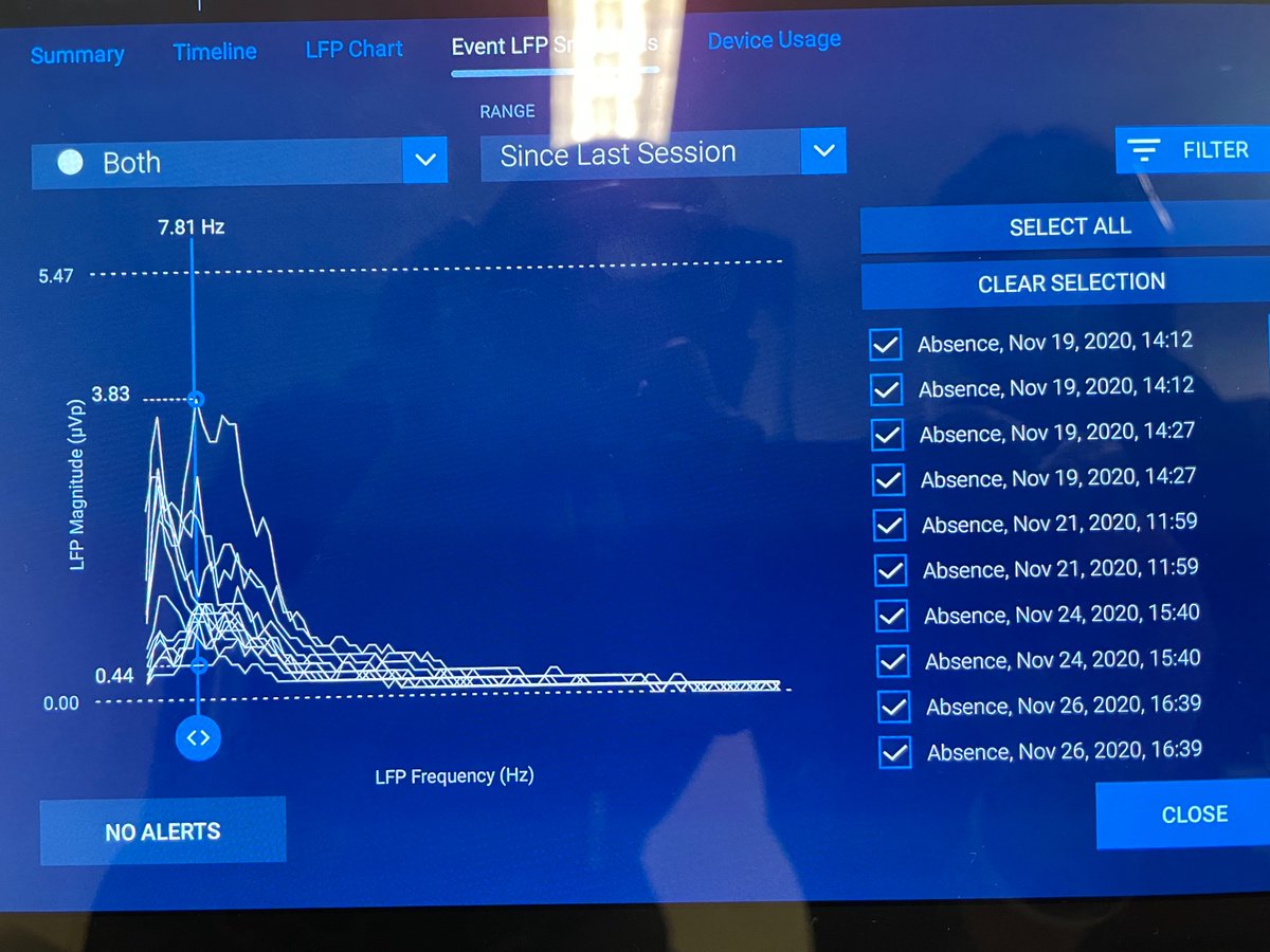Ladies and gentleman:
implanted chronic recording of absence #seizure with a peak at 3 and 8 Hz (leads in the ANT of the thalamus).
#dbs for #epilepsy has just entered a new era (thank you <a href="/kalialabs/">kalialabs</a>)

<a href="/GMI_Canada/">George M Ibrahim</a> 
@C_R_A_N_I_A 
<a href="/UHNSHSNeurology/">UHN&SHS Neurology</a>