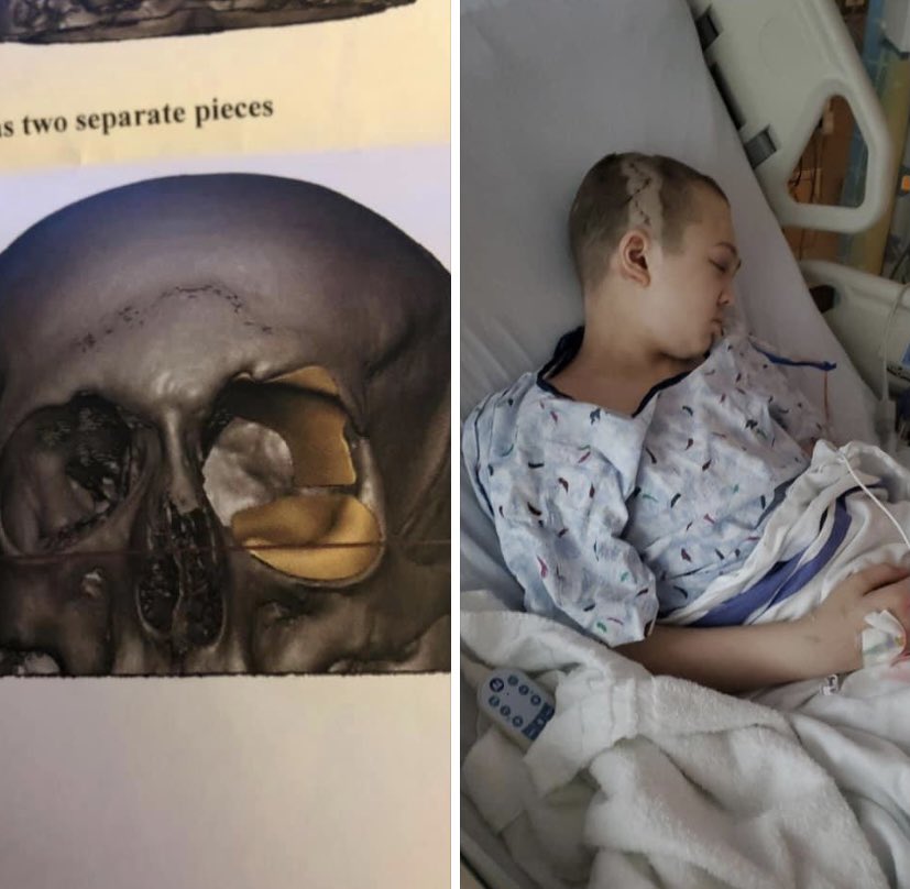 Can’t believe it’s been a month Picture is Tyler’s new implants. progress is going well,he still has some swelling that will take time to come down. Surgery #2 (5th overall)  March 24th back in Philadelphia. Keep are family in your daily thoughts and prayers.

#TeamTyler #EndNF