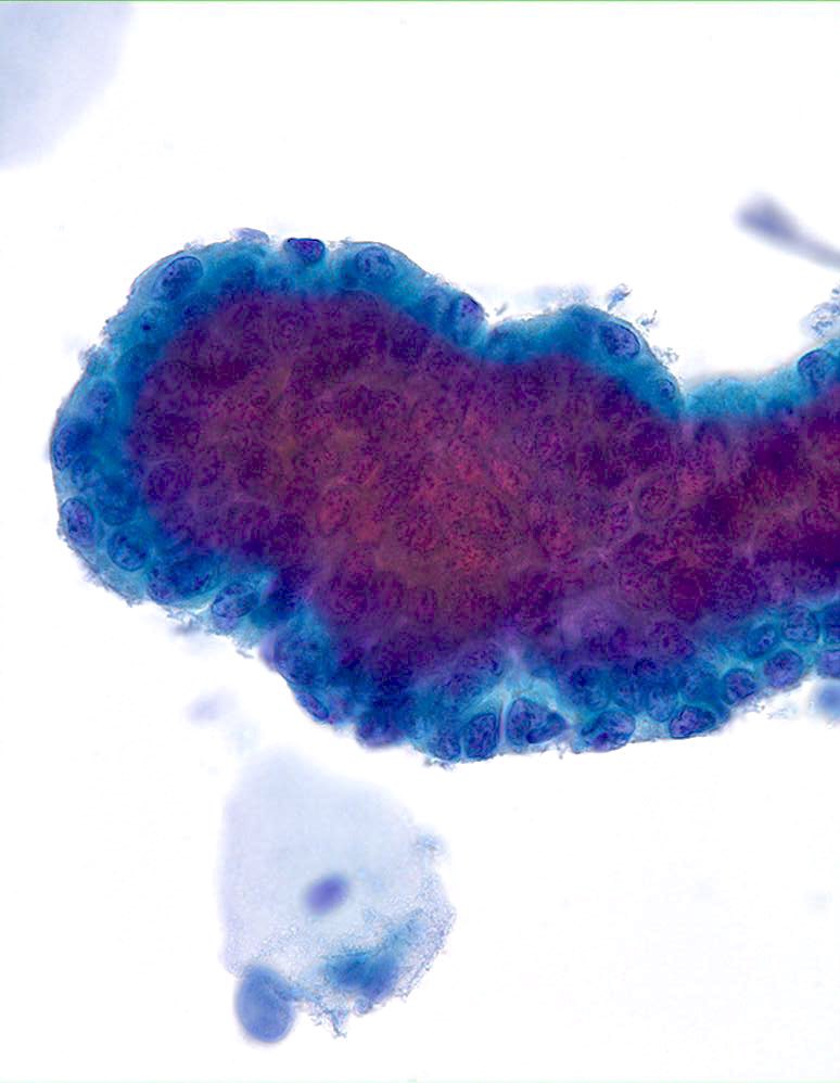 sza_jhcyto's tweet photo. The FORMIDABLE world of PAP Test Cytology. How high can one go on this scary-looking “Glandular” fragment? It was called “AGC-EC”. Follow-up showed an “Endocervical Polyp”. (ThinPrep) https://t.co/U230VEd7nB