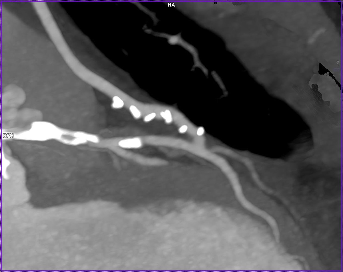 FaisalBakaeen's tweet image. The beauty of a patent LITA to LAD! @ClevelandClinic @TallRoundsTM
