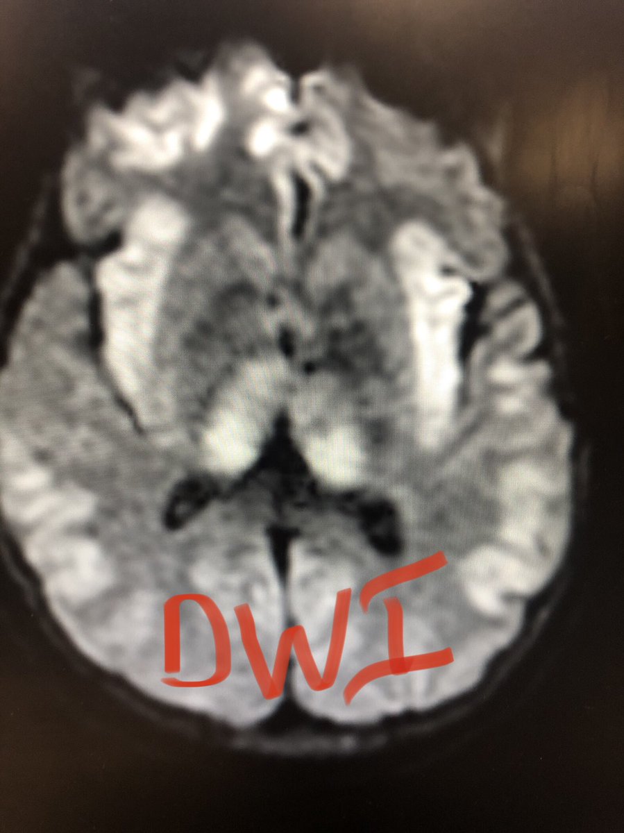 1/ Liver Failure & Damage: MRI Tips What does MRI show? Pt w/hepatic encephalopathy came in talking, then gets dense coma. No hypoxia & only minor shock. See T2 Flair, DWI & ADC imaging w diffuse Gray Matter Dz incl Thalamus  http://bit.ly/3lVfjI5&nbsp;  #medtwitter  #meded
