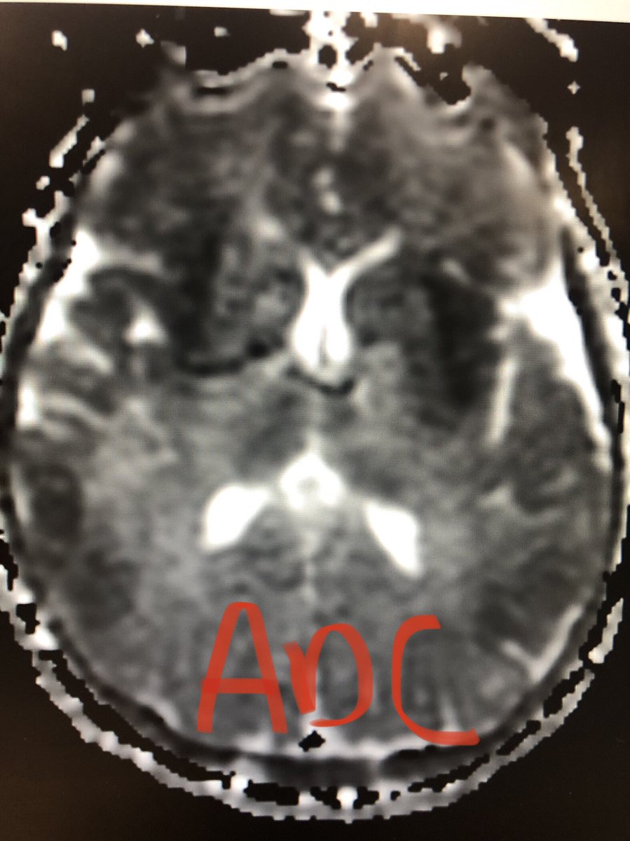 1/ Liver Failure & Damage: MRI Tips What does MRI show? Pt w/hepatic encephalopathy came in talking, then gets dense coma. No hypoxia & only minor shock. See T2 Flair, DWI & ADC imaging w diffuse Gray Matter Dz incl Thalamus  http://bit.ly/3lVfjI5&nbsp;  #medtwitter  #meded