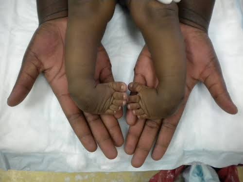 drpenking's tweet image. This condition is called Club Foot. An NGO is partnering with University of Uyo Teaching Hospital, Akwa Ibom State to treat this condition free of charge. These children will be attended to every Wednesday till the end of this year. Please Retweet. You might save a Child's future