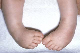 drpenking's tweet image. This condition is called Club Foot. An NGO is partnering with University of Uyo Teaching Hospital, Akwa Ibom State to treat this condition free of charge. These children will be attended to every Wednesday till the end of this year. Please Retweet. You might save a Child's future