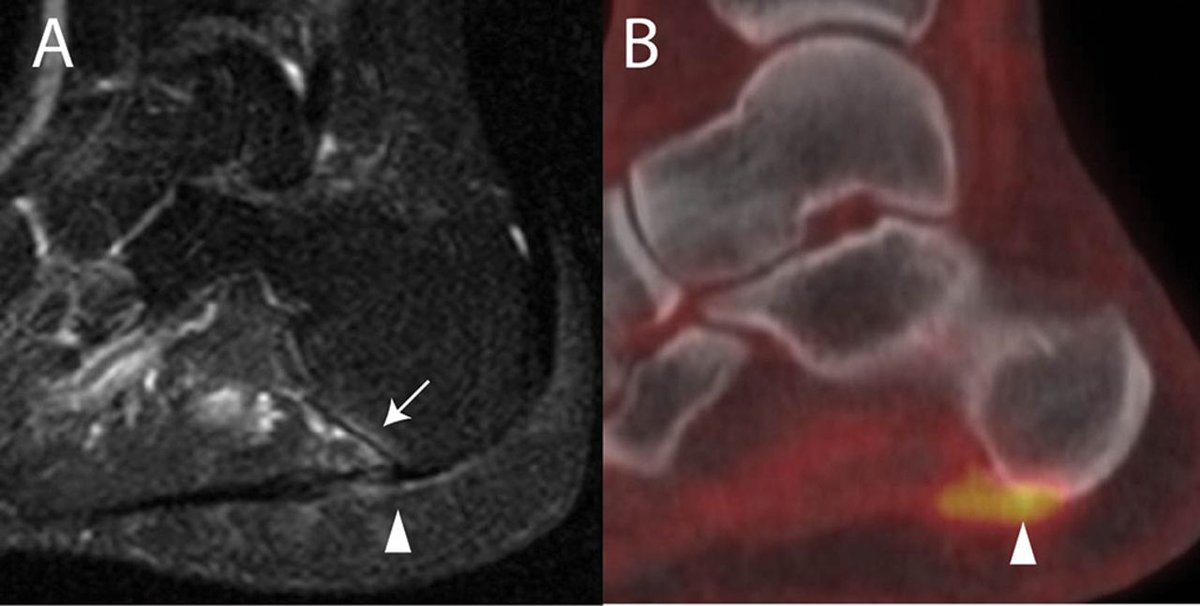 URRCI researchers also study the use of imaging  in spondyloarthropathy. Read about the Comparison of the Heel Enthesitis MRI Scoring System (HEMRIS) with clinical enthesitis and local metabolic activity on PET-CT @ARD_BMJ rmdopen.bmj.com/content/6/3/e0… #psoriaticarthritis #rheumatology