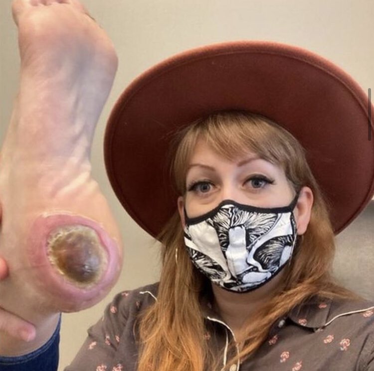 Patricia is suffering from an unexplained skin condition - but a misunderstanding about what might have caused it set off a chain of events that turned her foot into fodder for anti-vaccine activists.Here’s how - more across  @BBCNews TV, Radio and online today