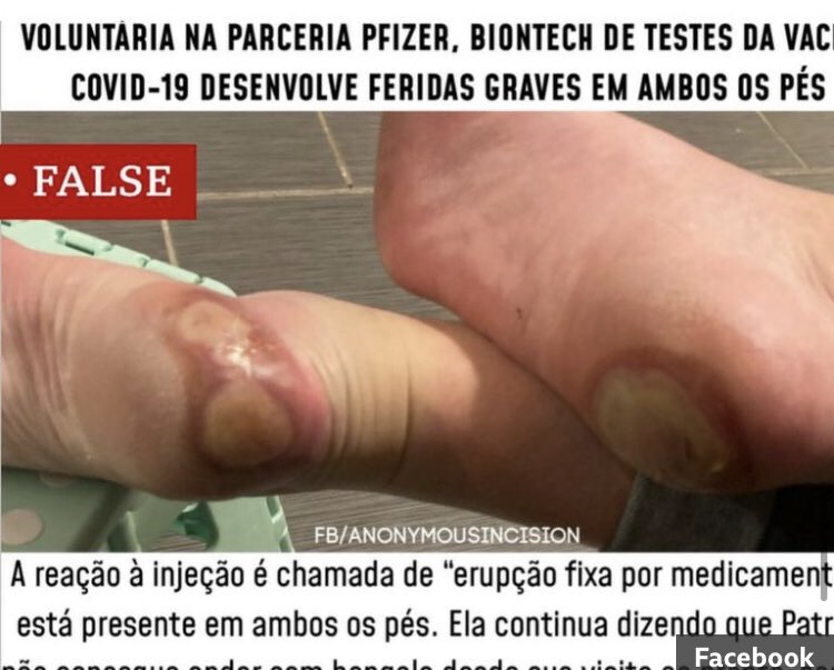 But that didn't stop activists twisting her story to advance their own agendas. Screen grabs of the Go Fund Me Page featuring her feet mistakenly claiming she was injured in the vaccine trial were shared in antivaxx circles and by pseudoscience influencers across the world.