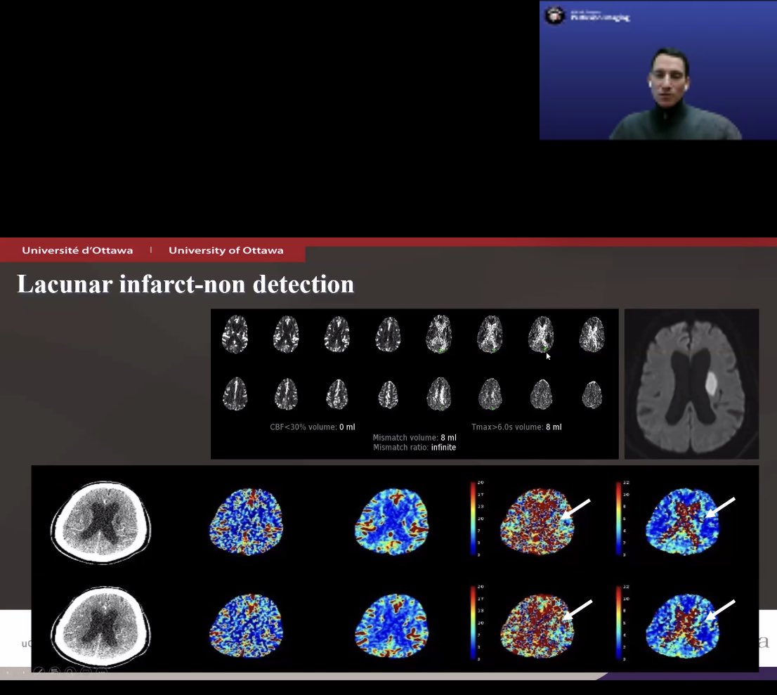 elmitte's tweet image. Although can’t attend all these great talks on #perfusion imaging live today, so glad @theASFNR makes them available for the members later on. Will crack them after cracking the ABR core exam! 
#ASFNRPresents #radresLife