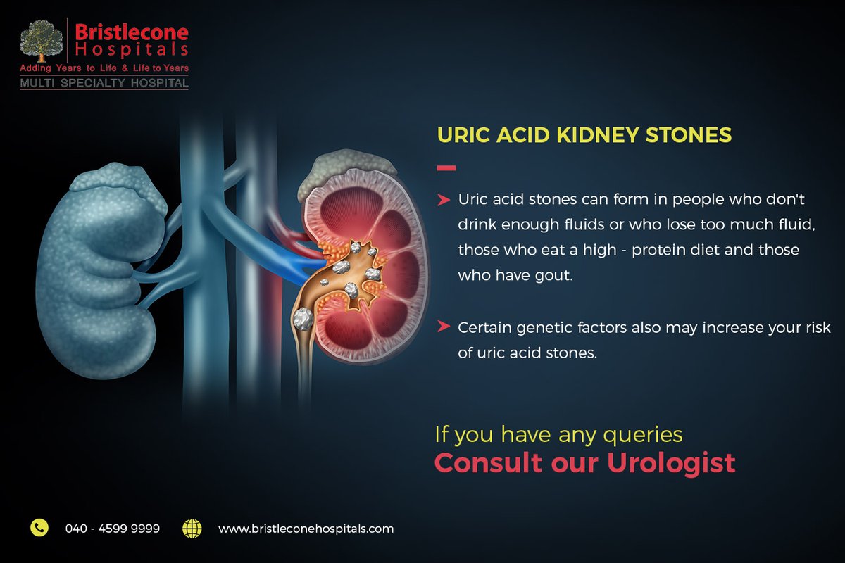 Uric Acid Kidney Stones

#Bristlecone #BristleconeHospitals #UricAcid #KidneyStone #Kidney #KidneyHealth #KidneyDisease #KidneyStones #Medicine #Health #Urology #HealthyLifeStyle #KidneystoneRemoval #ReasonsForKidneyDisease #ayurvedaliving #KidneyDiseaseSymptoms #BestHospitals