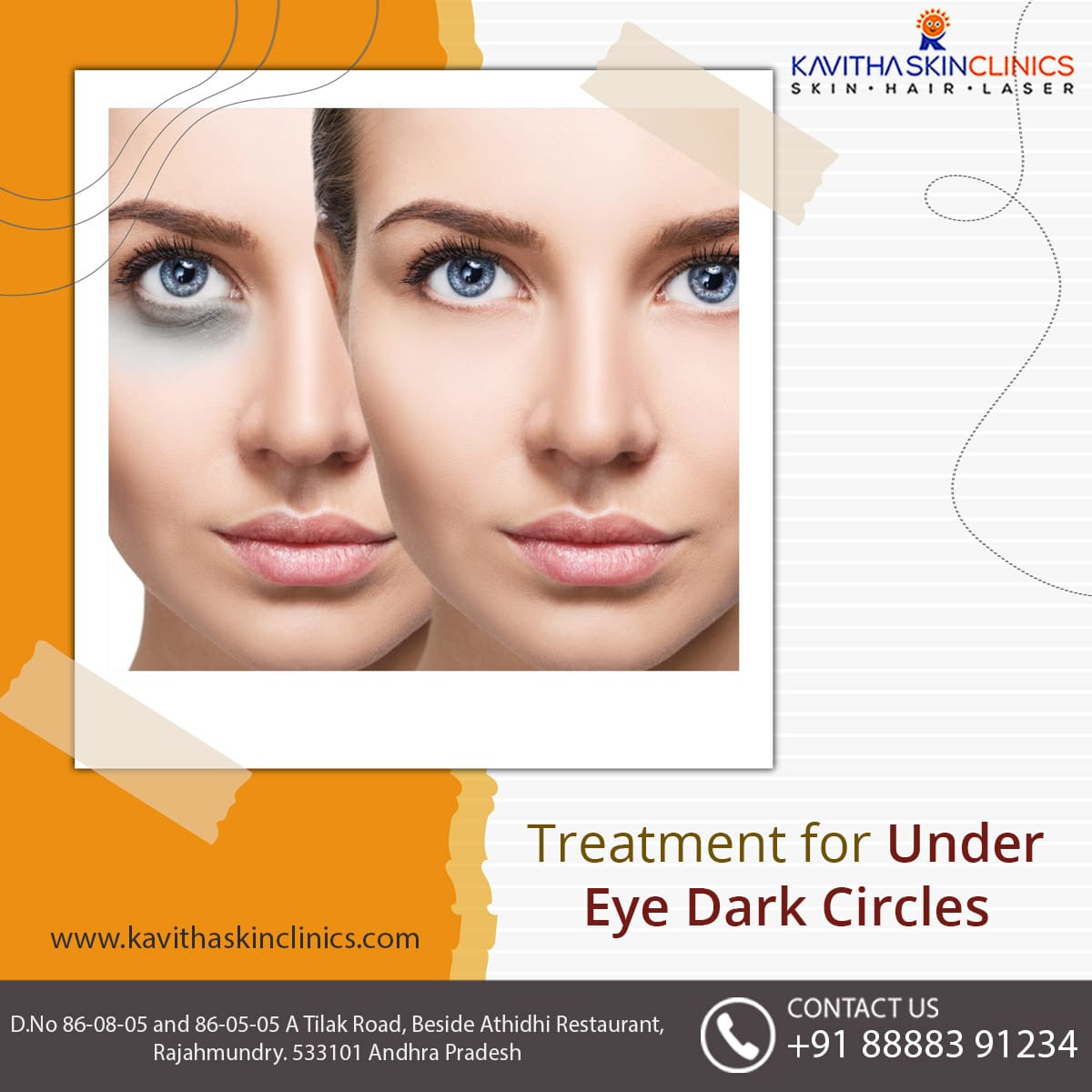 SkinKavitha's tweet photo. Treatment for Under Eye Dark Circles.
Contact us: 8888391234
Mail us: kavitha@kavithaskinclinics.com
#skincare #hospital #rajahmundry #cosmetic #dermatologist #skinhospitals #allskintreatments #skincareclinic #skincarehospitals #skincareherbal #beauty #skin #skinsoft https://t.co/81oZj3GwTF