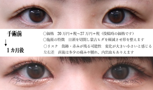 目頭の世界 白目の面積拡大 内側の白目が小さい ということで来られる方も多いです ごく自然に横方向の目の拡大を行っていました 目頭切開 T Co Ezmaj36zd1 Twitter