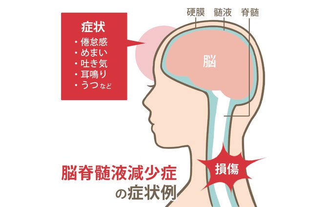 脳脊髄液減少症のtwitterイラスト検索結果 脳脊髄液減少症のtwitterイラスト検索結果