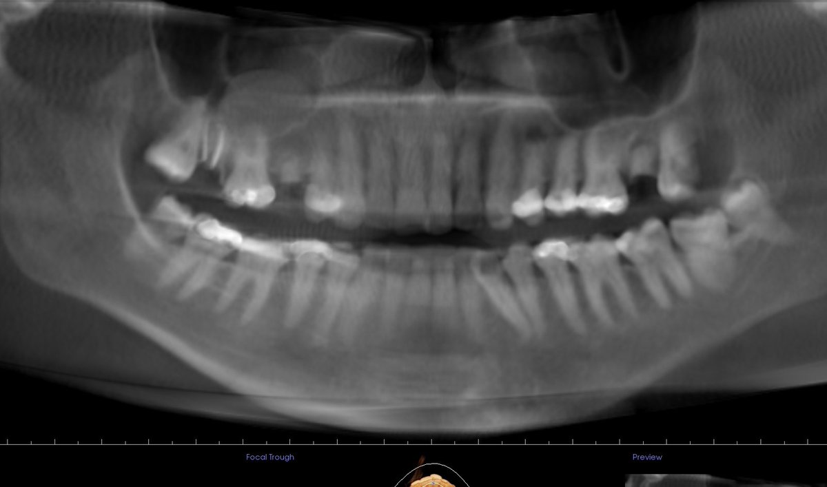 Fun case of too many molars. #radiographoftheday
