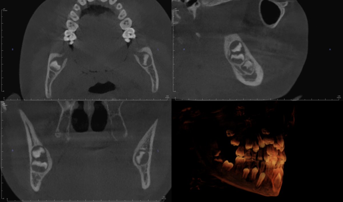 This is interesting - a developing supernumerary tooth (distodens) clashing with a developing third molar. #radiographoftheday