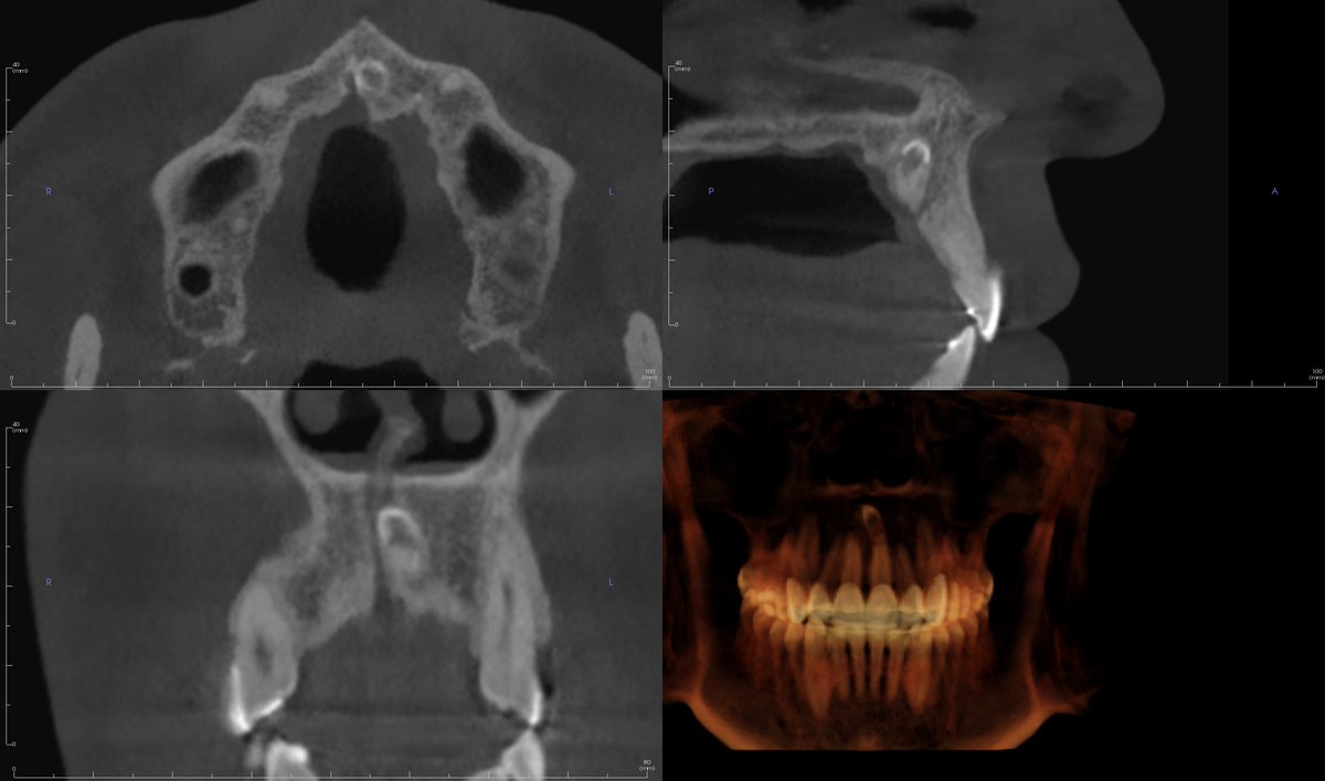 A tiny supernumerary tooth (mesiodens) undergoing resorption. #radiographoftheday