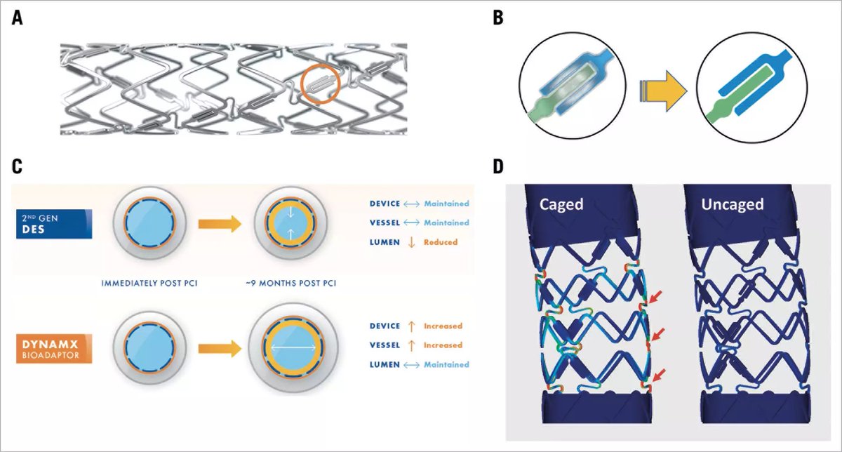 EuroIntervention (@eurointerventio) on Twitter photo "Twelve-month clinical and imaging outcomes of the uncaging coronary DynamX bioadaptor system" by Stefan Verheye et al. #EAPCI
bit.ly/2R8qqR8 "Twelve-month clinical and imaging outcomes of the uncaging coronary DynamX bioadaptor system" by Stefan Verheye et al. #EAPCI
bit.ly/2R8qqR8