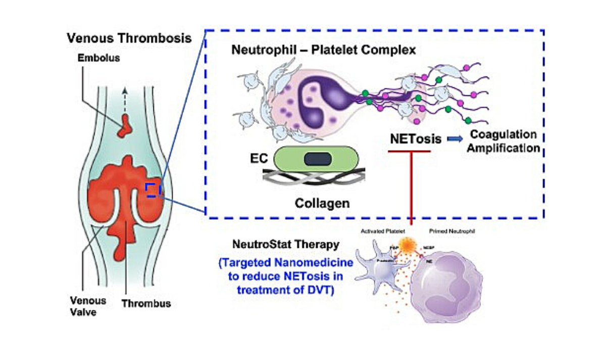 CWRU Biomedical Engineering (@cwrubme) on Twitter photo NeutroStat is a therapeutic technology that received funding from the most recent round of CCTRP Awards.
Developed by Evi Stavrou and BME Professor <a href="/JishnuSenGupta/">Anirban Sen Gupta</a>, NeutroStat promises to improve therapeutic safety and efficacy in the treatment of venous thromboembolism. NeutroStat is a therapeutic technology that received funding from the most recent round of CCTRP Awards.
Developed by Evi Stavrou and BME Professor <a href="/JishnuSenGupta/">Anirban Sen Gupta</a>, NeutroStat promises to improve therapeutic safety and efficacy in the treatment of venous thromboembolism.