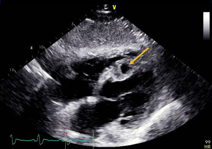 Ventricular Septal Rupture and Cardiogenic Shock Complicating STEMI during COVID-19 Pandemic: An Old Foe Re-Emerges dlvr.it/Rp8gV5