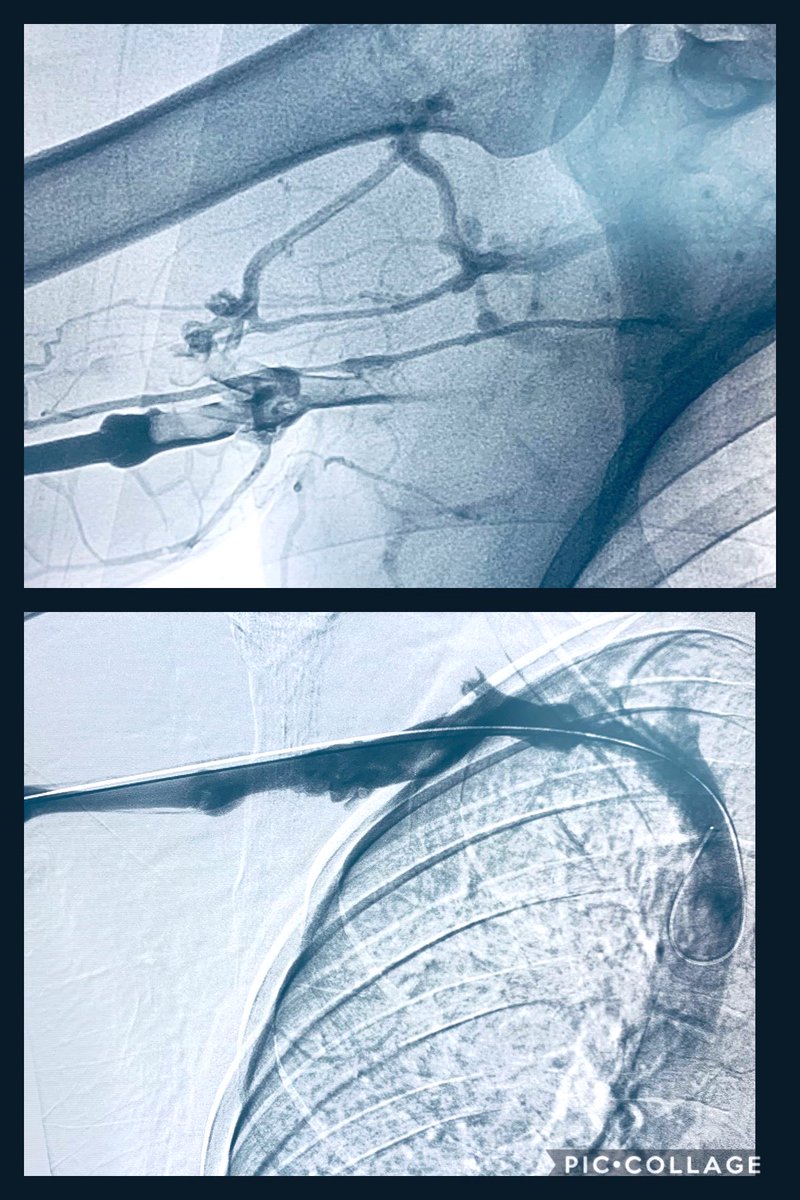 t_intheleadcoat's tweet photo. Construction worker, spontaneous RUE #DVT, pain, swelling & inability to flex hand.
Rx ~30 mins ,flouro <10 mins , EBL~200 ml #singlesessionthrombectomy @InariMedical #Flowtriever #NoTPA #NoICU
@keithppereira might say 4fr #CDT 🤣, pt given options.
VS referral TOS👍🏾 https://t.co/43Pl4kF1hP