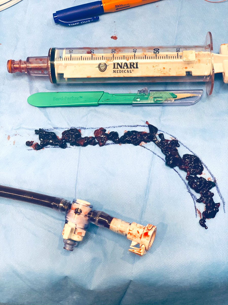 t_intheleadcoat's tweet photo. Construction worker, spontaneous RUE #DVT, pain, swelling & inability to flex hand.
Rx ~30 mins ,flouro <10 mins , EBL~200 ml #singlesessionthrombectomy @InariMedical #Flowtriever #NoTPA #NoICU
@keithppereira might say 4fr #CDT 🤣, pt given options.
VS referral TOS👍🏾 https://t.co/43Pl4kF1hP