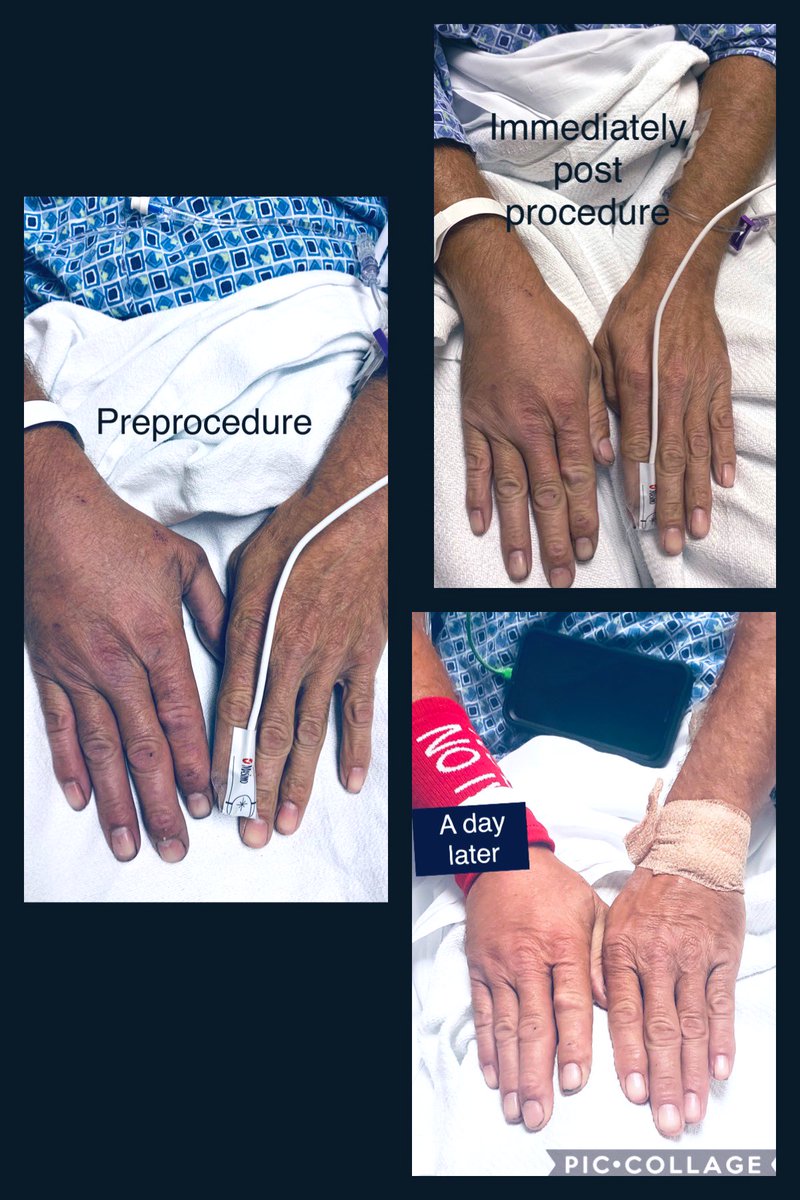 t_intheleadcoat's tweet photo. Construction worker, spontaneous RUE #DVT, pain, swelling & inability to flex hand.
Rx ~30 mins ,flouro <10 mins , EBL~200 ml #singlesessionthrombectomy @InariMedical #Flowtriever #NoTPA #NoICU
@keithppereira might say 4fr #CDT 🤣, pt given options.
VS referral TOS👍🏾 https://t.co/43Pl4kF1hP