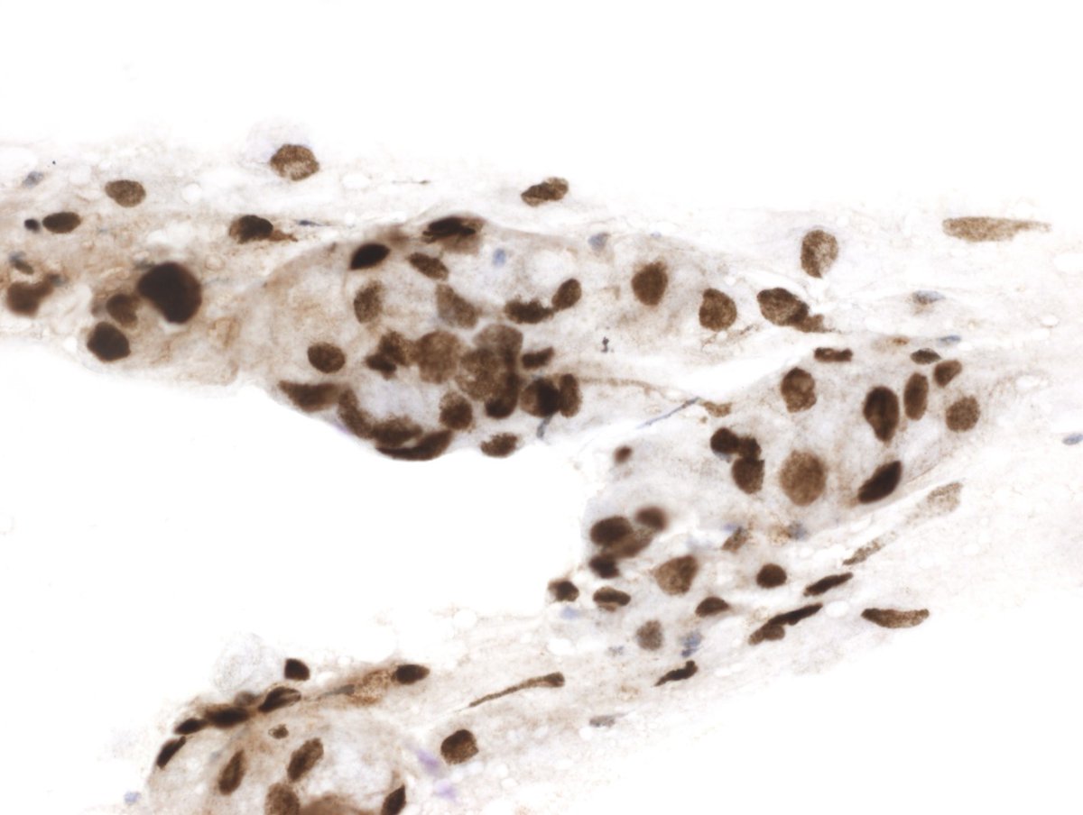 Following Dr. Ali's <a href="/sza_jhcyto/">Syed Z. Ali</a> unique insights. My humble tribute: from cruising altitude to landing and.... welcome gift. Supraclavicular LN: signet ring cell adenocarcinoma metastasis of lung origin