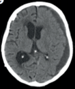 Chronic subdural haematoma ( #CSDH) is a common neurological condition in elderly individuals, and its incidence is rising due to an ageing population and increasing use of anticoagulant and antiplatelet medication. #Neurosurgery  #neurology  #geriatrics