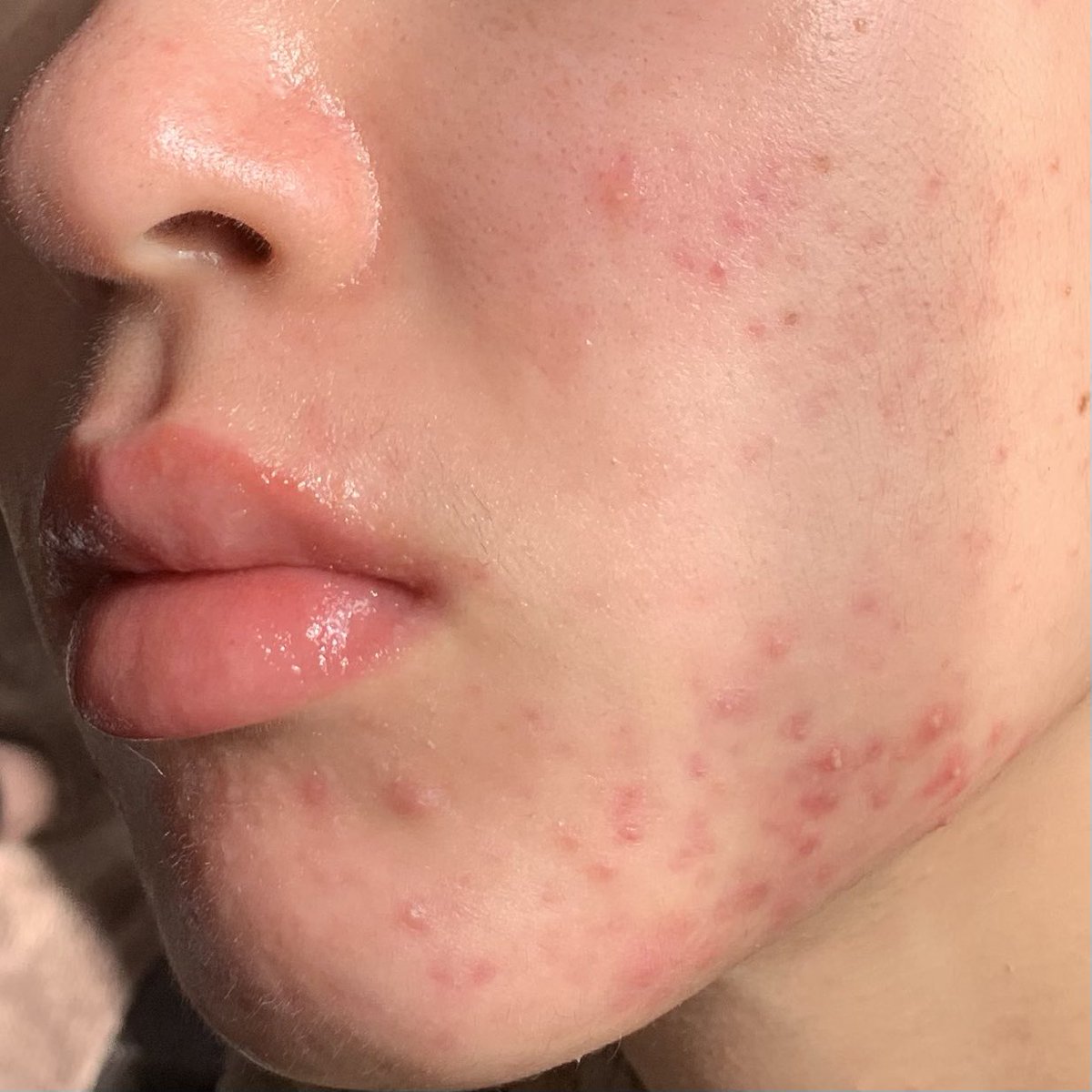 Nikちゃん アキュテイン1ヶ月と14日目 ニキビは相変わらず元気 ベビーオイル洗顔良い乾燥気にならない 唇 皮膚科行ったら1発で治ったわ 弱いステロイドの薬っていうから辞めた時不安あるけど アキュテイン 大人ニキビ ニキビ治療