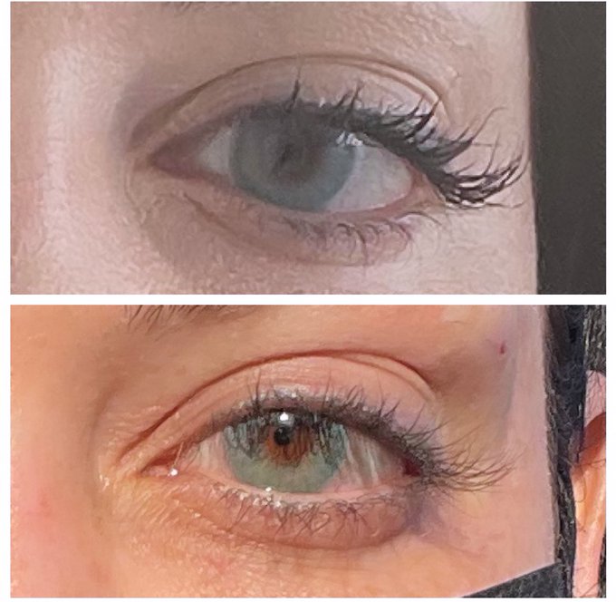 Got a thread lift today for my eyes. Just two threads on each side. Please note that the extreme &lsquo;fox<a href="/tag/married"class="tags"><span>#married</span></a><a href="/tag/lovestory"class="tags"><span>#lovestory</span></a><a href="/tag/pheromones"class="tags"><span>#pheromones</span></a>