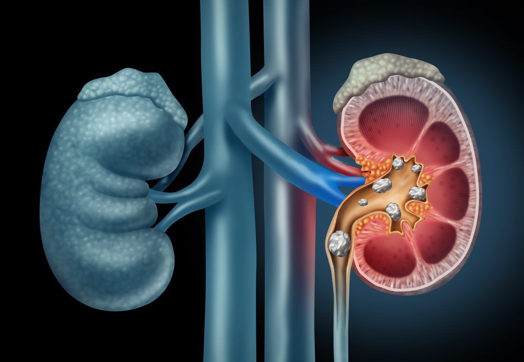 What causes kidney stones (and what to do): bit.ly/37l1yhY #HarvardHealth