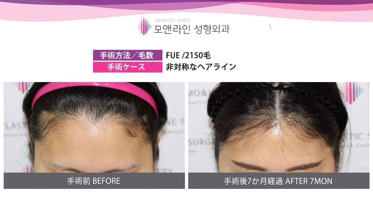モ ヘアーライン美容整形外科 ヘアライン矯正は ヘアラインを綺麗に整えるだけでなく 小顔効果 洗練された女性らしい印象 第二の輪郭整形効果 を見ることができます ヘアライン矯正 毛髪移植 ミニヘアライン矯正 大量毛髪移植 再矯正 モ ヘアーライン美容整形外科 ヘアライン矯正は ヘアラインを綺麗に整えるだけでなく 小顔効果 洗練された女性らしい印象 第二の輪郭整形効果 を見ることができます ヘアライン矯正 毛髪移植 ミニヘアライン矯正 大量毛髪移植 再矯正