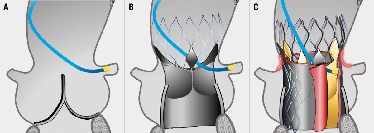 EuroIntervention (@eurointerventio) on Twitter photo "A computed tomography study of coronary access and coronary obstruction after redo #TAVI" by Nicola Buzzatti <a href="/azeemlatib/">Azeem Latib</a> et al. #EAPCI
bit.ly/32CjZwt "A computed tomography study of coronary access and coronary obstruction after redo #TAVI" by Nicola Buzzatti <a href="/azeemlatib/">Azeem Latib</a> et al. #EAPCI
bit.ly/32CjZwt