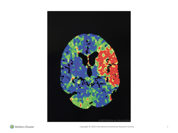 IARS_Journals's tweet photo. 🔴 There is increasing evidence that the use of brain function monitoring by processed #EEG and brain oxygenation monitoring by near-infrared spectroscopy are useful adjuncts for improving patient care in the perioperative period #NIRS (1/2) 

 https://t.co/Sgz8vKjSDV https://t.co/ATDj3p4zry