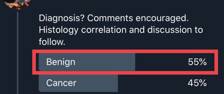 1. Discussion: Interesting voting trend. “Benign” held the early slight majority, then some astute people suggested metastatic lobular carcinoma. The voting them swung decidedly towards “cancer”!