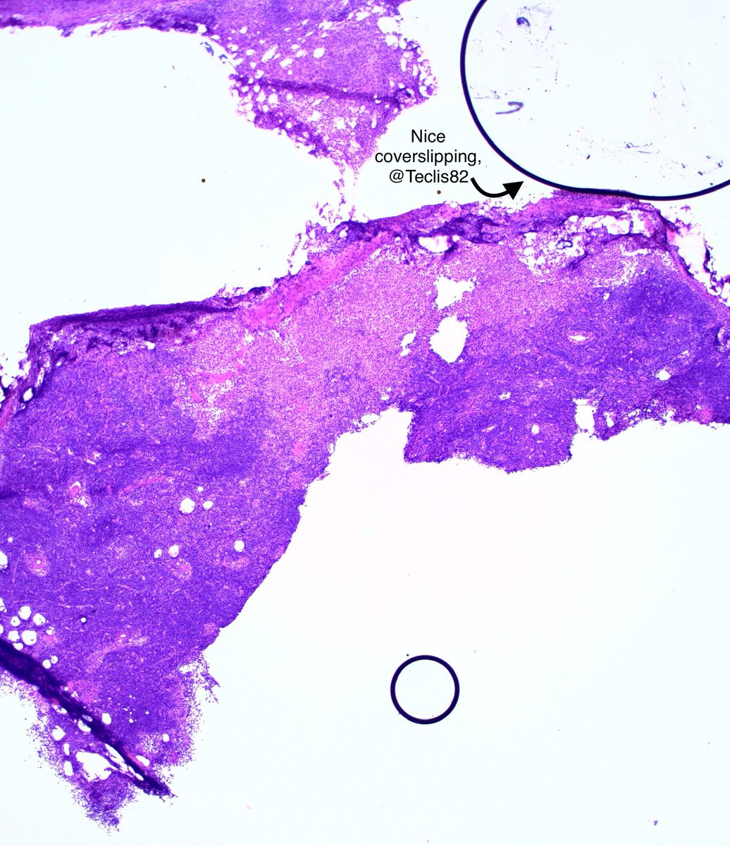 2. Atypical cells on touch prep prompted the following frozen section:
