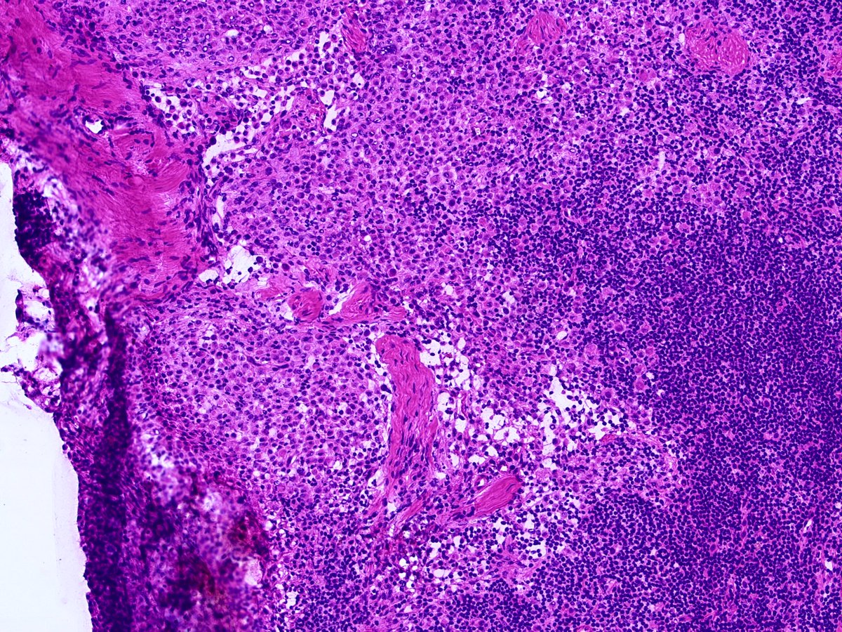 2. Atypical cells on touch prep prompted the following frozen section: