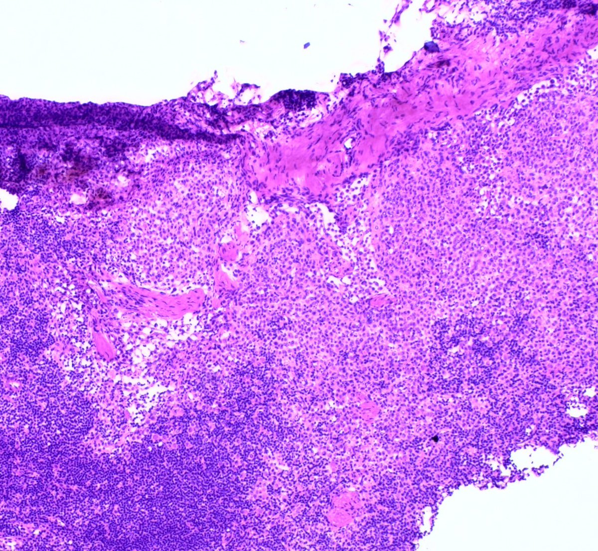 2. Atypical cells on touch prep prompted the following frozen section: