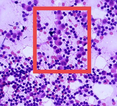 Let’s look back at the cytology. I’ve included a cytology: histology correlation slide.