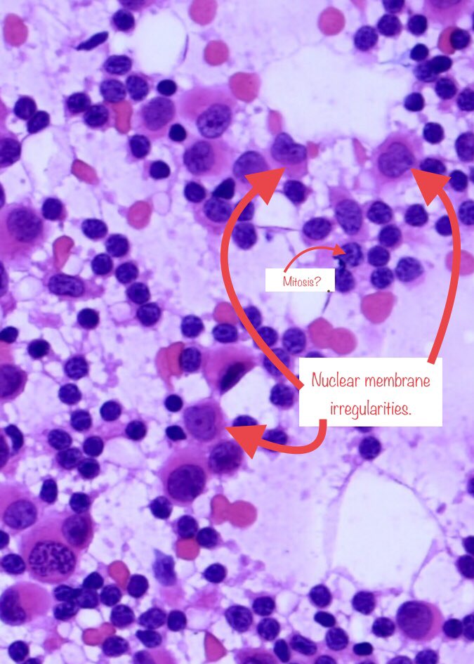6. Some annotated images showing the atypical features of the red box cells above.None of these are specific; histiocytes may resemble lobular cancer cells. However, taken together, these atypical features should raise concern for malignancy, and prompt a frozen section.