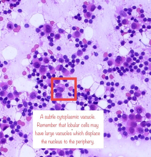 8. Also welcome any input form  #cytopath experts, I am definitely not one (  @doc_kartik  @Sara_Jiang  @DCSkipperDO  @oreoimc  @DrGeeONE  @VandaTorousMD and anyone else)