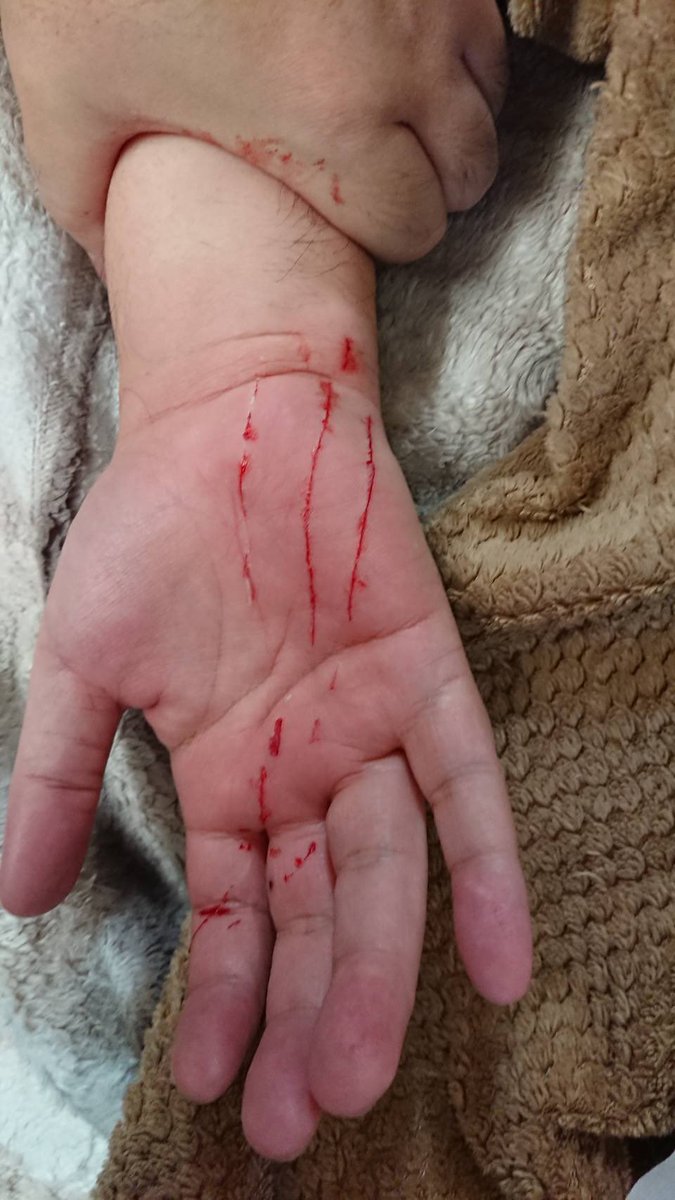 運勢が良くないようなので手相を変えてみました。。。
痛いよ〜、凶器はなんでしょう！
綺麗な花には棘がある。可愛い顔してやっぱり凶器を隠し持っていました。久々にやられた〜